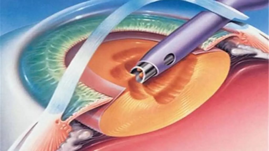 cirurgia de catarata em joinville